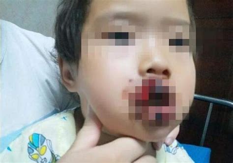 4歲女童被自家養土狗咬掉嘴唇，家人憤怒將狗打死 每日頭條