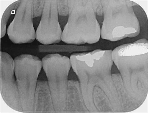 Limpieza Dental Radiografías Bite Wing Dcto en Cuponatic