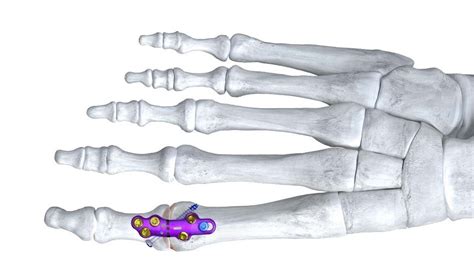 1st Mtp Joint Big Toe Joint Fusion Dr Mike Smith Adelaide