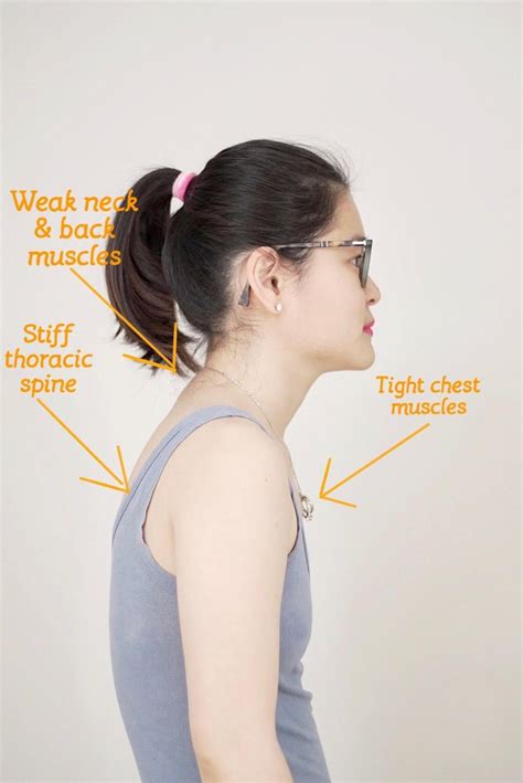 How To Fix Rounded Shoulder Capital Physiotherapy