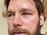 Video Chris Pratt Reveals He Was Stung By A Bee In His Eye Daily