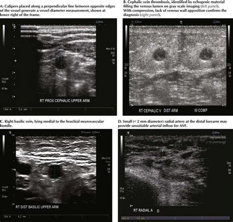 Upper Extremity Arteriovenous Access For Hemodialysis Basicmedical Key