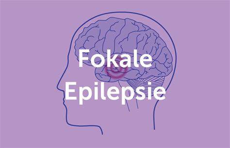 Generalisierte Epilepsie Absence Anf Lle Ucbcares