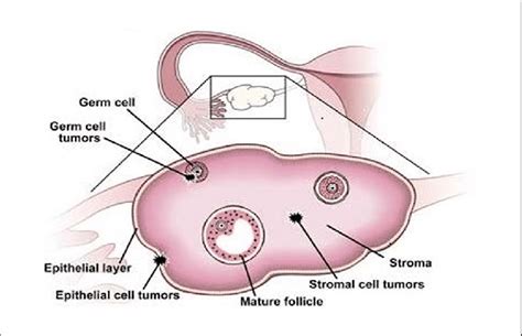 Ovarian Tumors Are Categorized Based On Their Most Likely Tissue Of