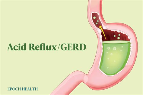 Acid Reflux And Gerd Symptoms Causes Treatments And Natural