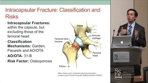 Hip Fractures In The Elderly Clinical Anatomy Peter Collin Youtube