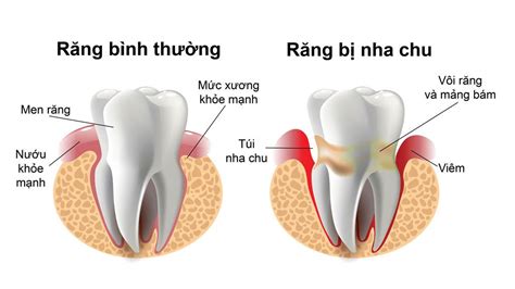 Những điều cần biết về bệnh viêm quanh răng nha chu