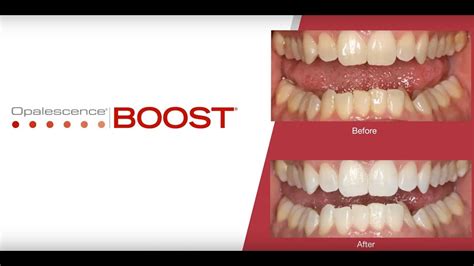 Opalescence Boost For In Office Whitening Cleveland Smile Center