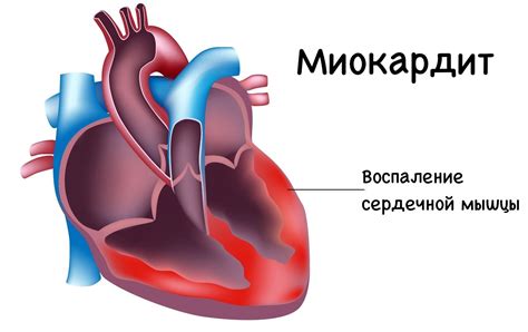Миокардит - лечение, симптомы, диагностика, последствия - likarni.com