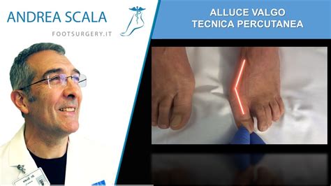 Alluce Valgo Tecnica Percutanea Alluce Valgo Prima E Dopo Dott