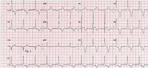 Left Ventricular Aneurysm Complicating Apical Hypertrophic