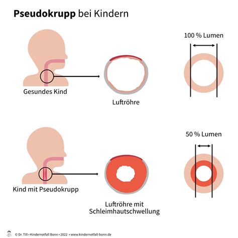 Pseudokrupp Anfall Alles was Eltern wissen müssen