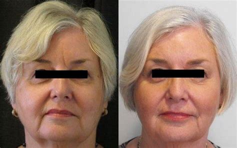 Dermal Fillers Before And After Photos Palm Clinic