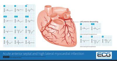 Male Years Old Clinically Diagnosed As Acute Extensive Anterior