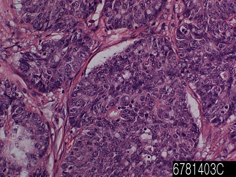 Colon Adenocarcinoma Pd Xelonet