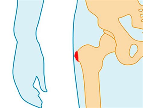 Slijmbeursontsteking Heup Podotherapie Zeist