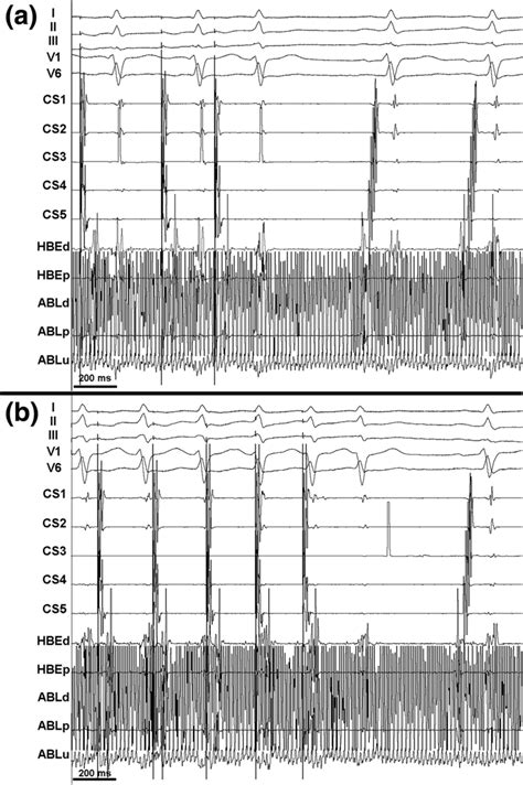 Ab Same Patient As In Fig 2 In A After Tachycardia Interruption Download Scientific Diagram