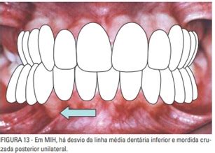 VIAGEM PELA ORTODONTIA Oclusão normal na denticao decídua Claudia e