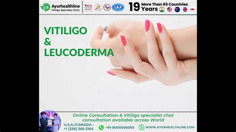 Vitiligo And Leukoderma Know The Causes Symptoms And Treatment Youtube