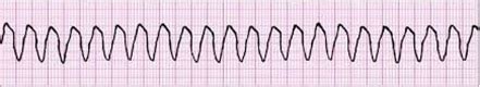 Shockable Rhythms: Ventricular Tachycardia, Ventricular Fibrillation ...