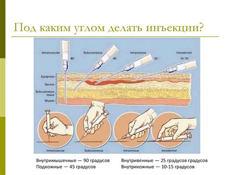 Уколы внутримышечно самостоятельно: Как сделать укол самому дома?