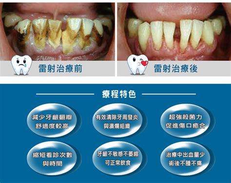 多麗美學牙醫診所 水雷射牙周治療