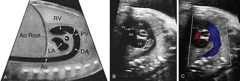 Sonographic Evaluation Of The Fetal Heart Radiology Key