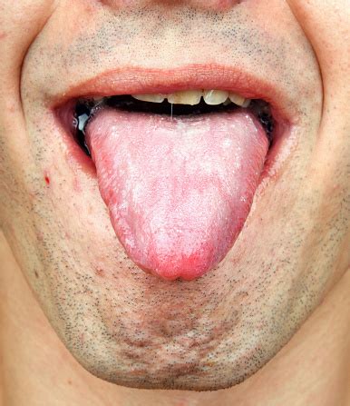 Bacterial Infection Tongue Stock Photo & More Pictures of Adult - iStock