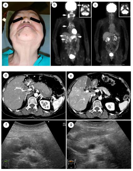 Ijms Free Full Text Steroid Therapy And Steroid Response In