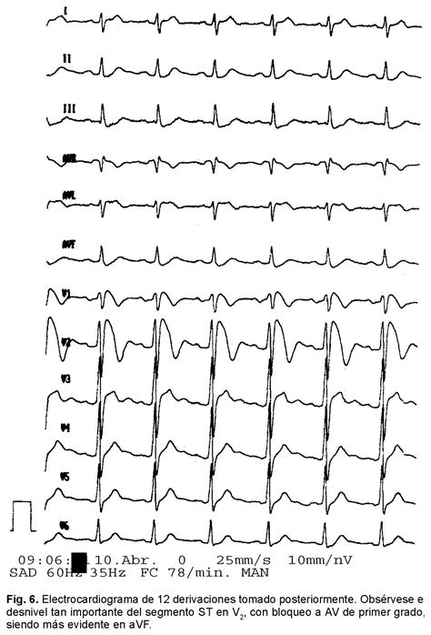 Alteraciones Electrocardiogr Ficas Durante El Esfuerzo En Un Paciente