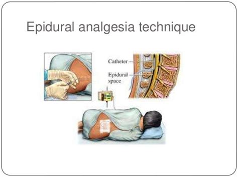 Analgesia In Thoracic Surgery