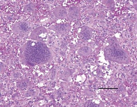 Histology Of The Tumor Consists Of Osteoclast Like Giant Cells