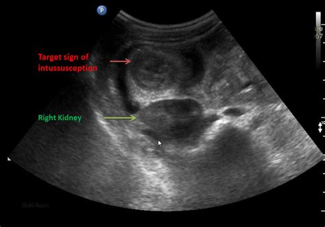 Pseudokidney Intussusception Radiology Reference Article