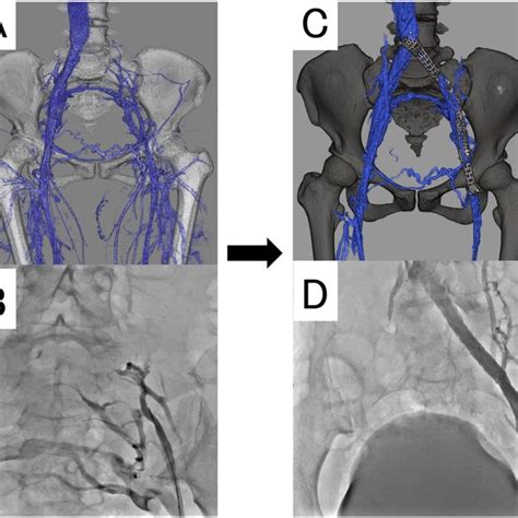 A 26 87 3 10 1 3 Common Iliac Vein Civ 3 10 Civ External Iliac