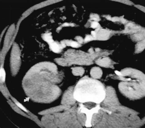 Transitional Cell Carcinoma Of The Upper Urinary Tract Spectrum Of Imaging Findings Radiographics