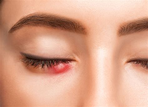 Chalazion Cyst In Eyelid Removal Surgery Optimal Vision