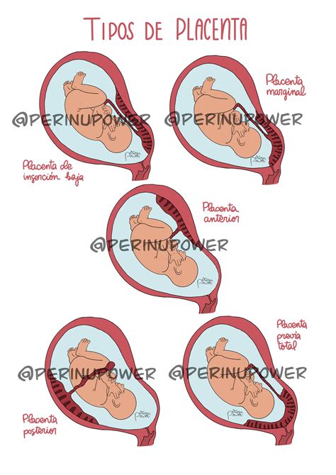 Placenta Posterior Grau 1 RETOEDU