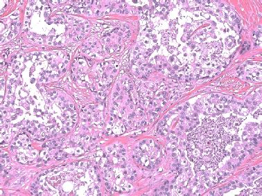 Squamoid Eccrine Ductal Carcinoma A Frequently Misdiagnosed Entity