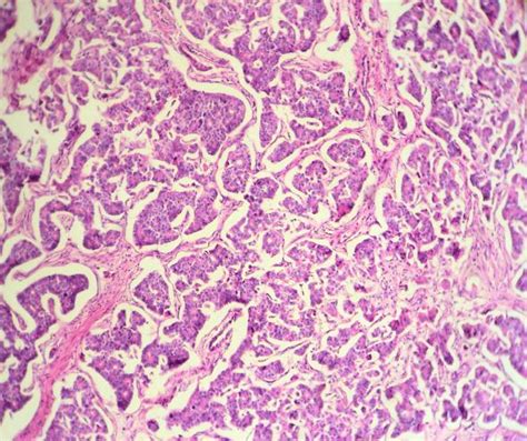 Photomicrograph Of The Testicular Tumor Showing Fig 4 Download