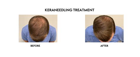 Kerafactor Hair Growth Treatment North Bethesda MD