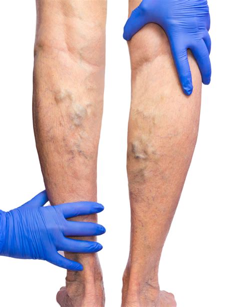 Signs And Symptoms Of Vein Disease Innovative Vein Center