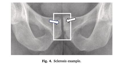 Classification Des Changements Radiographiques De La Symphyse Pubienne