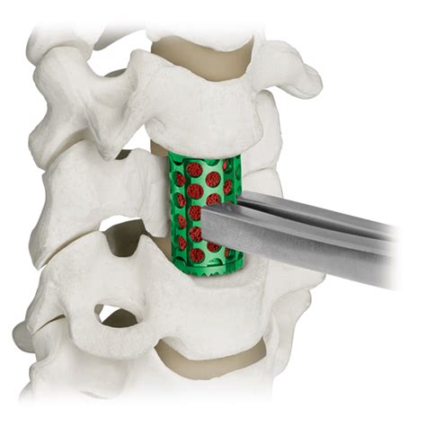 Colosseum™ Corpectomy Spacer Globus Medical