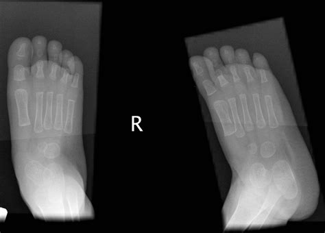 Congenital Vertical Talus Image Radiopaedia Org