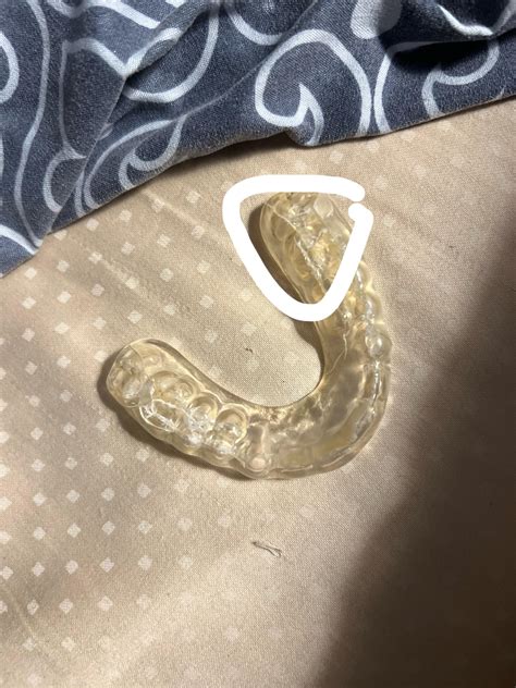 Can I keep wearing these? : r/Invisalign
