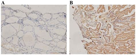 The Expression Level Of Wnt Member 5a In A Normal Thyroid Tissues And