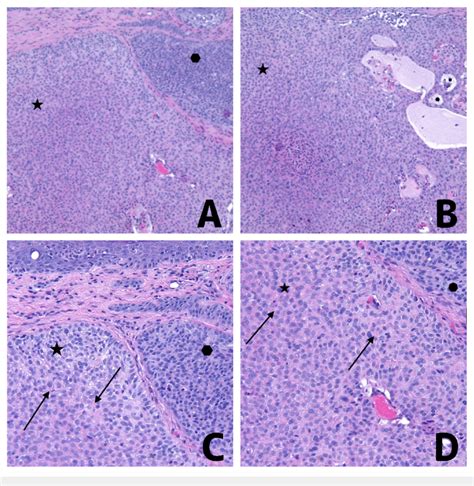 Pathology Features Of Basal Cell Carcinoma With Myoepithelial