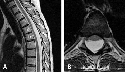 Intradural Arachnoid Cyst In A 37 Year Old Woman She Experienced