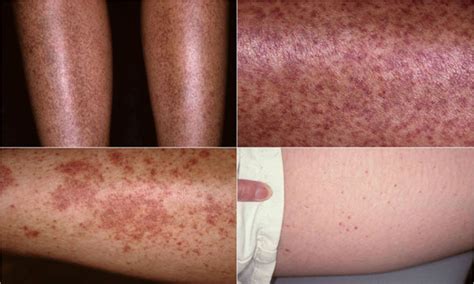 Sjögrens Syndrome Dermatology Advisor