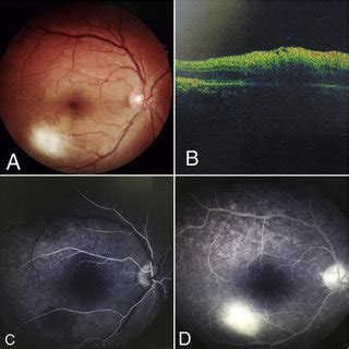 Summary Of The Transmission And Pathogenesis In Ocular Toxoplasmosis